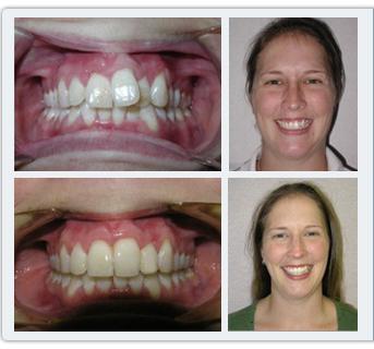 braces prije i poslije fotografije