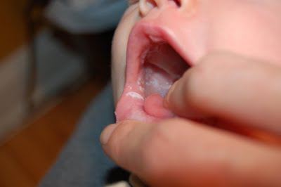 bijela prevlaka na jeziku djeteta