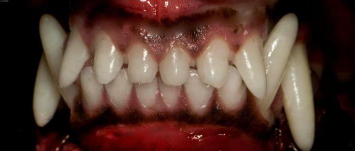 Ispravan i neispravan zagriz zuba: opis, fotografija, ispravak