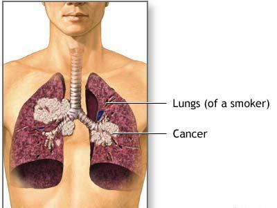 Rak pluća: koliko žive? Moram li vjerovati prognozama?